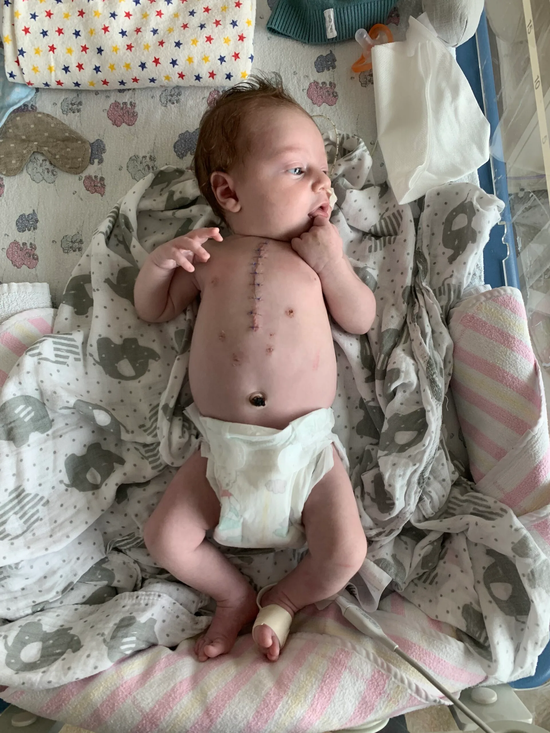 A baby wearing a nappy, he has stiches down his chest. 