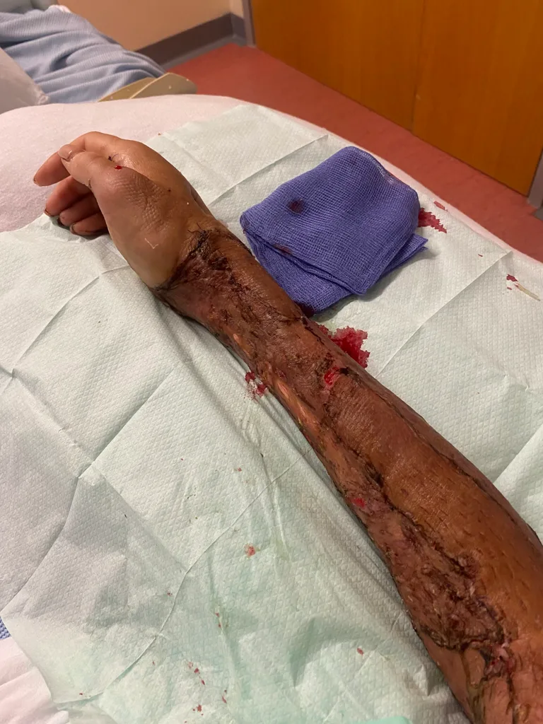 Image of womans hand after skin graft surgery