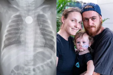 Left: An X-ray with a button battery. Right: A family photo.