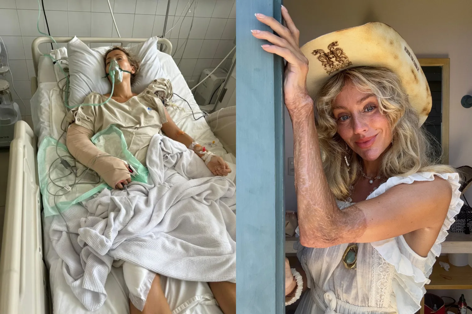 Image of woman in hospital after freak accident and image of woman smiling wearing cowboy hat showing skin graft scars