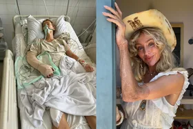 Image of woman in hospital after freak accident and image of woman smiling wearing cowboy hat showing skin graft scars