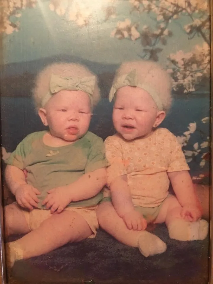 Twins with albinism Mikayla (left) and Megan (right) as babies