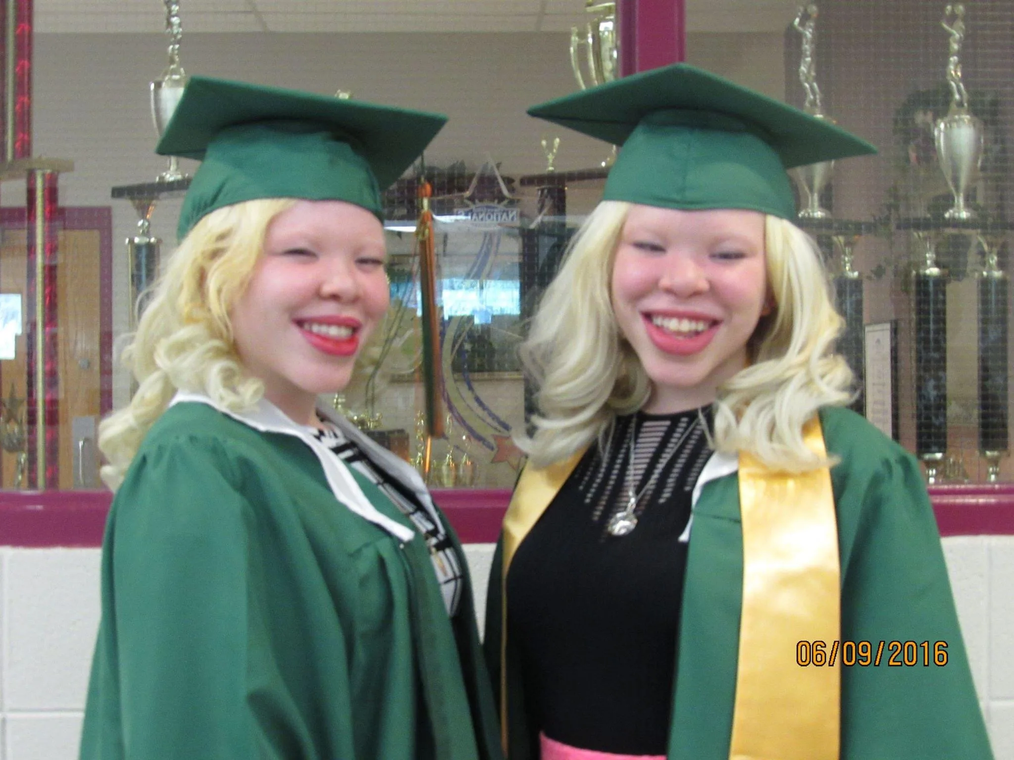 Twins with albinism, Mikayla (left) and Megan (right), at their graduation
