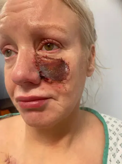 Image of woman in hospital following sausage dog attack