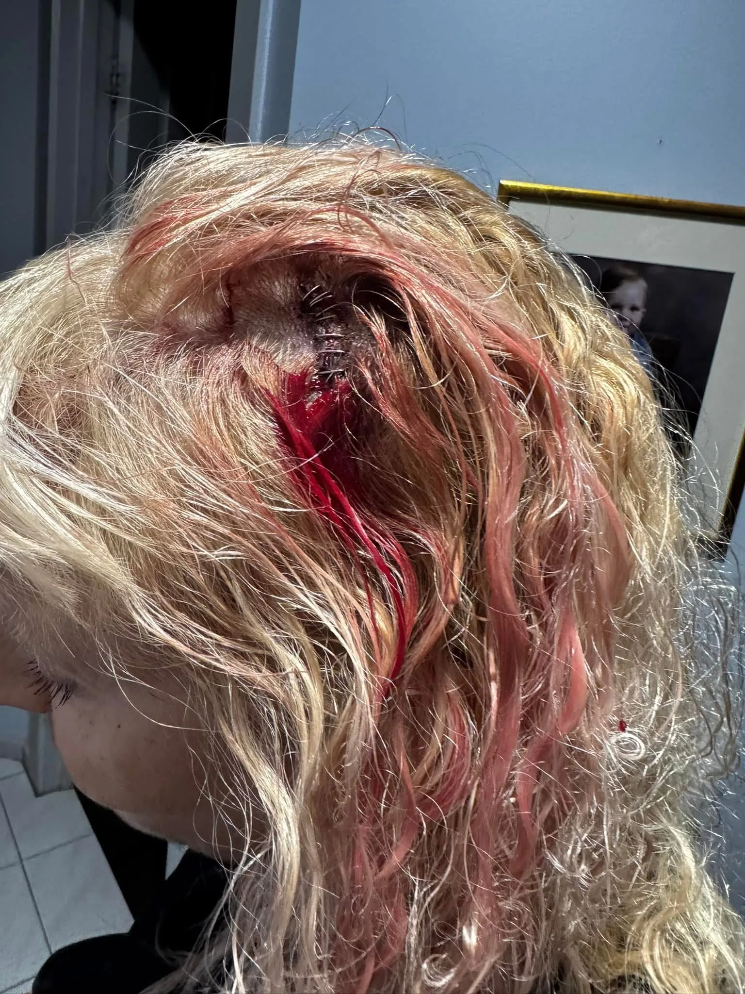A gash on Marilyn's head which has been stapled in hospital