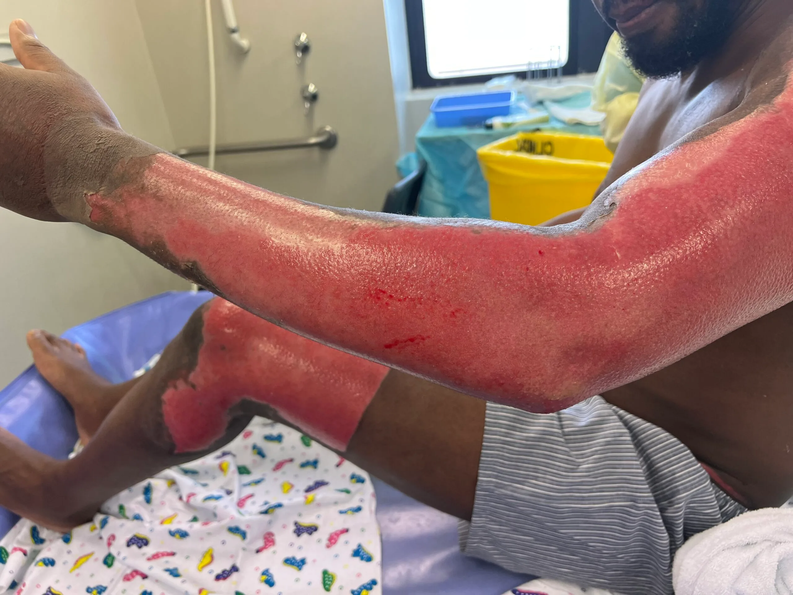Image of man in hospital after being burned alive