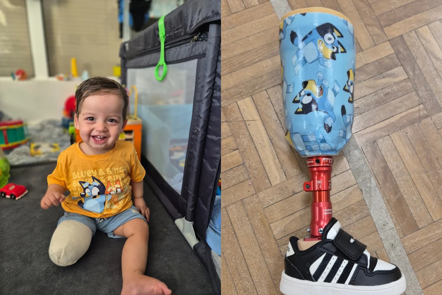 Image of young boy wearing yellow shirt and showing leg amputation. Second image of cartoon Bluey inspired prosthetic leg
