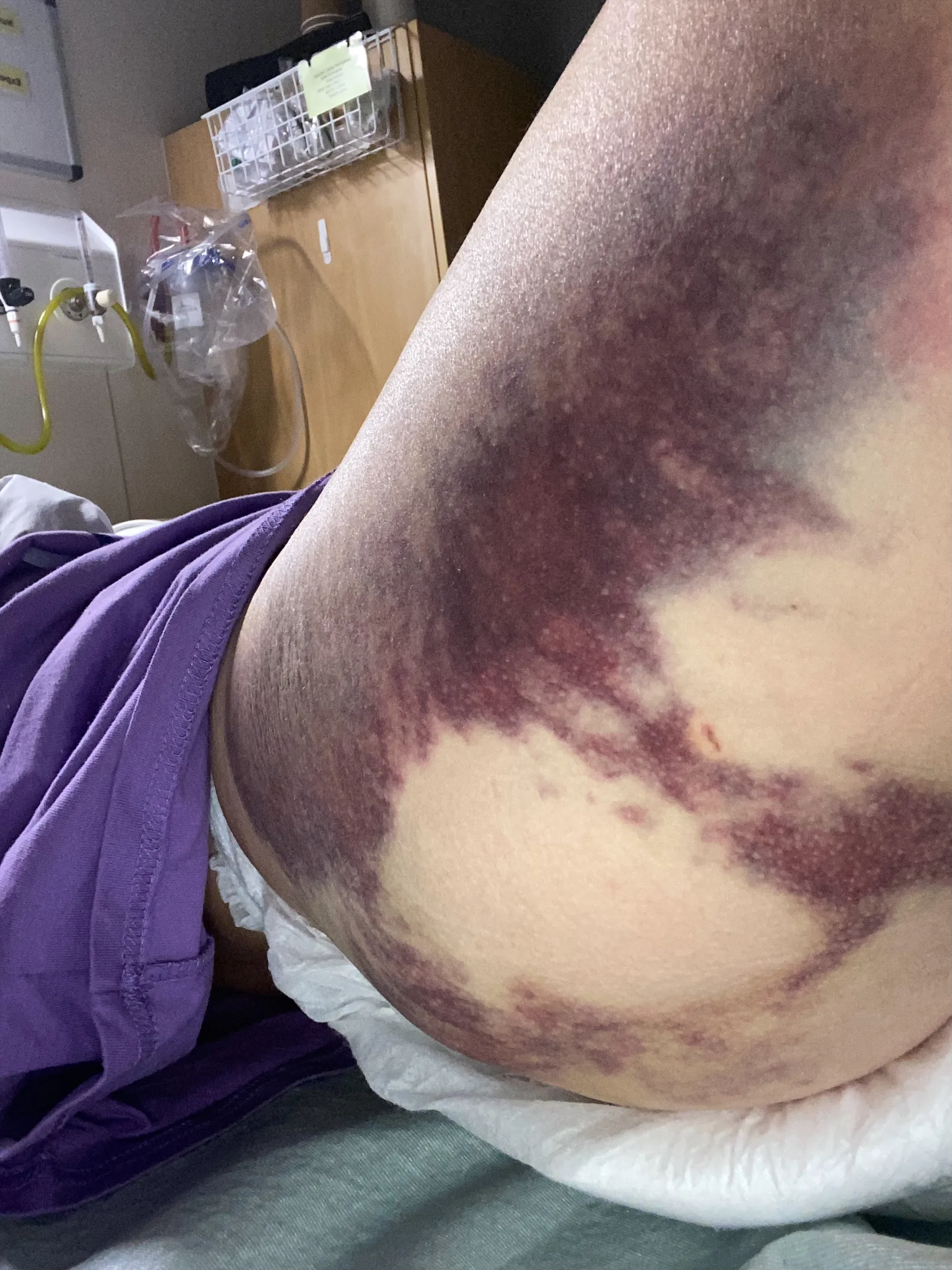 a leg bruised purple