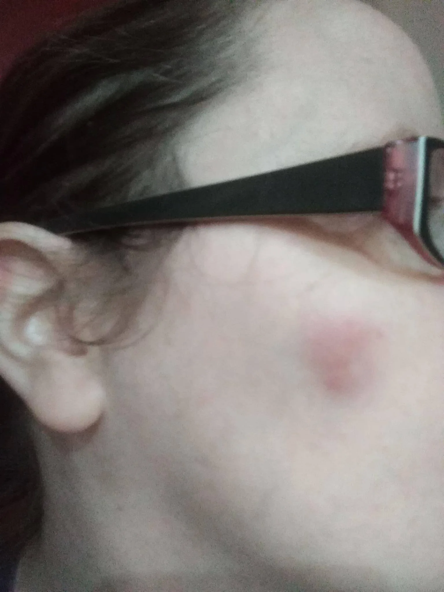 a woman wearing glasses with a red mark on her cheek