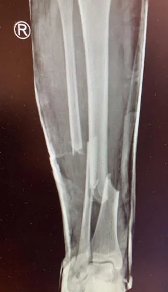 xray of a leg bone 