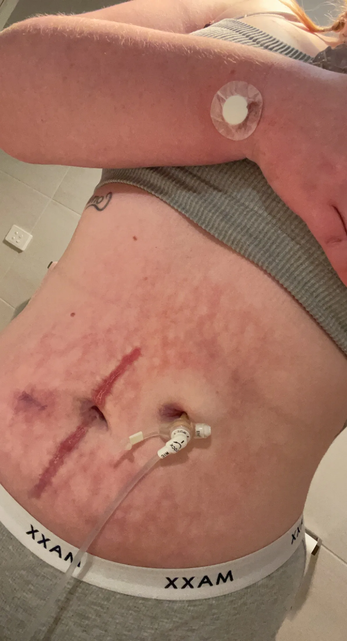 Tess' abdomen showing scars from multiple major abdominal surgeries & her feeding tube