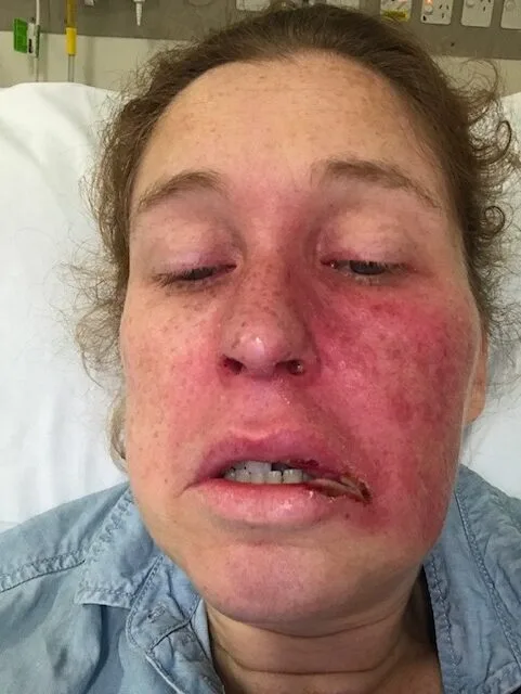 WOMAN IN BLUE TOP WITH RED SIDE OF FACE