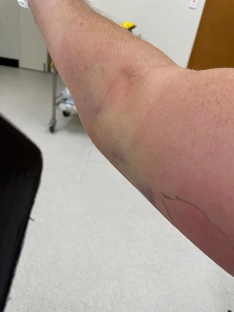 Image of mans arm, sepsis started with just a bump