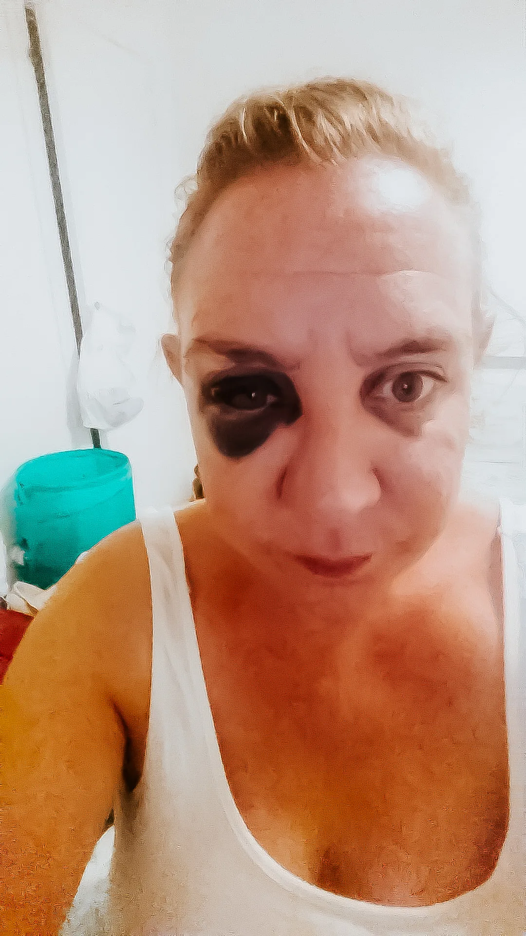 Woman with fractured black eye.