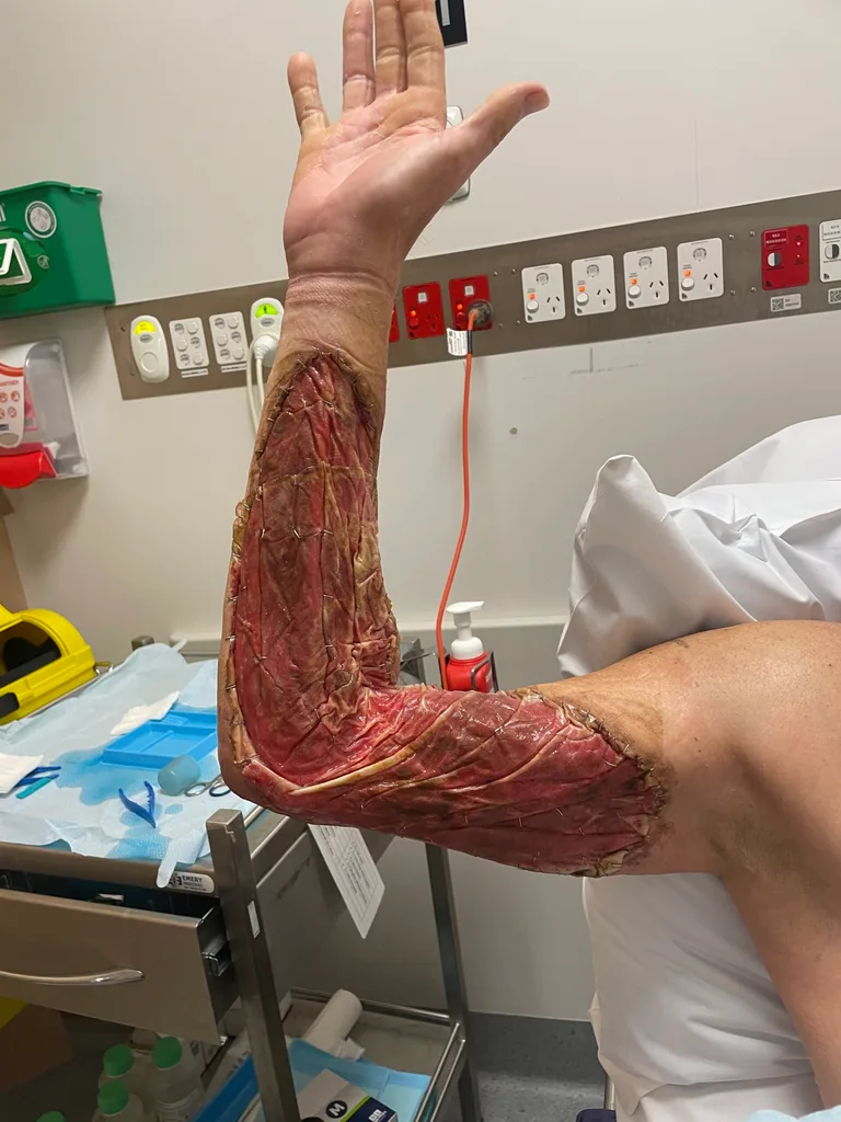 Image of mans arm after skin graft surgery