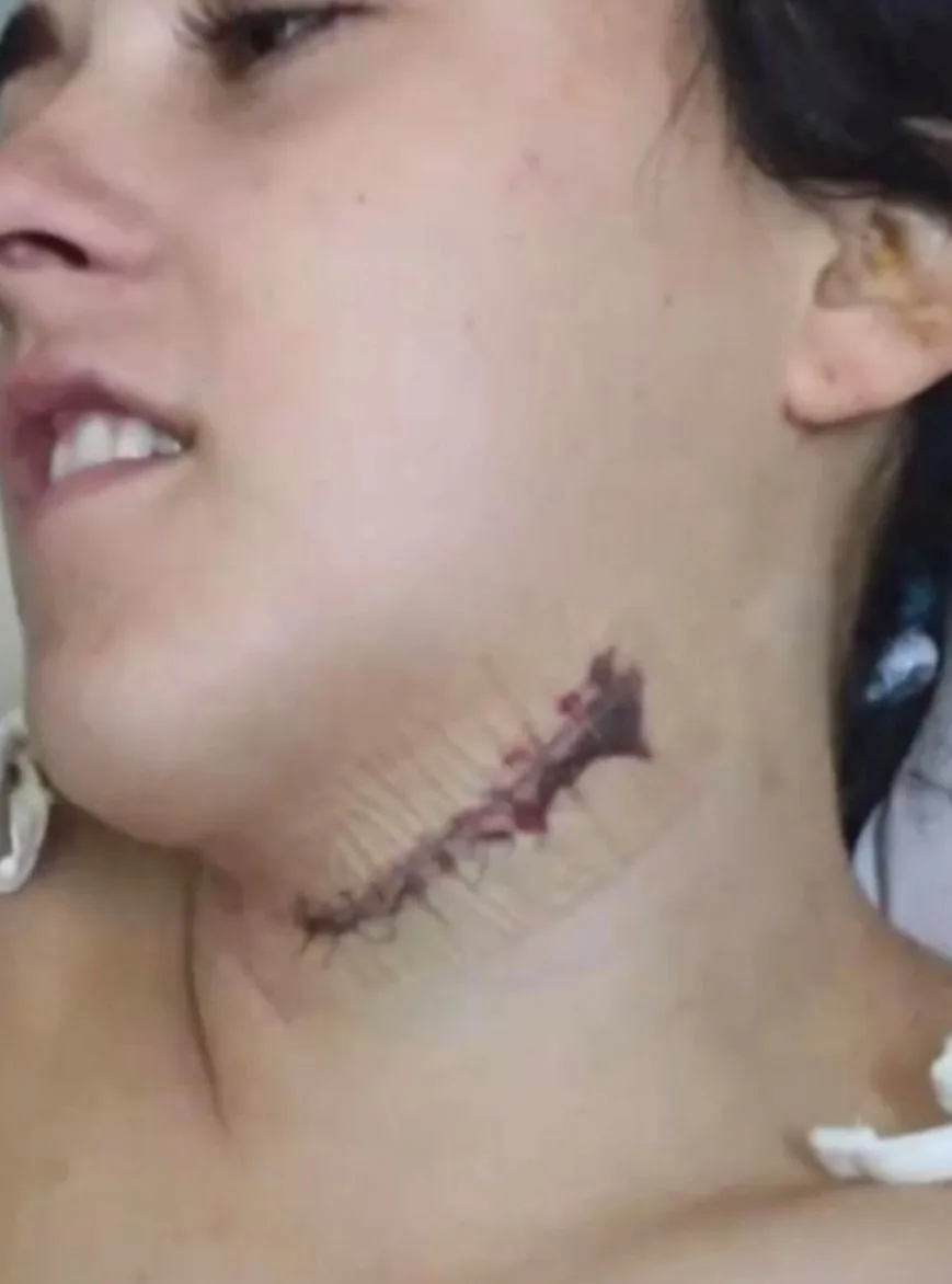 A close up of stiches in a woman's neck