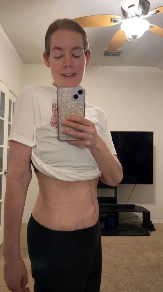 Smiling woman showing her stomach post-operation