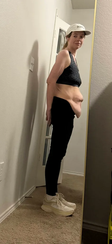 Woman with excess tummy skin after losing weight