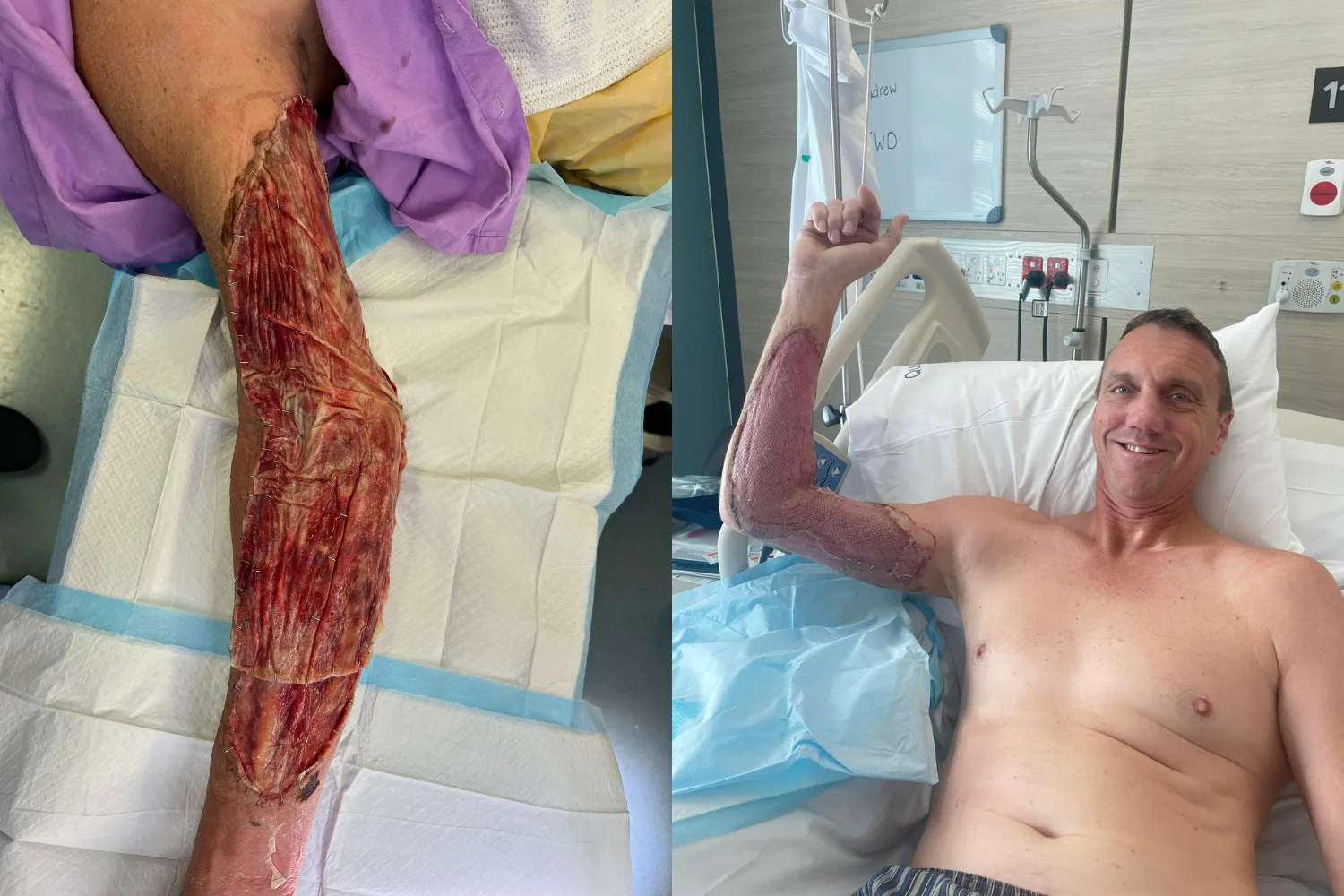 Image of sepsis infected arm (left) image of man recovering from septic shock in hospital (right)