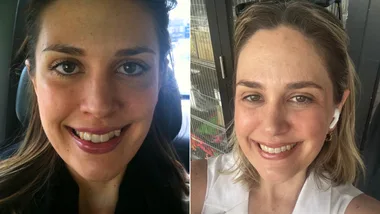 I paid $10k for straight teeth as an adult. Here’s what I wish I knew first.