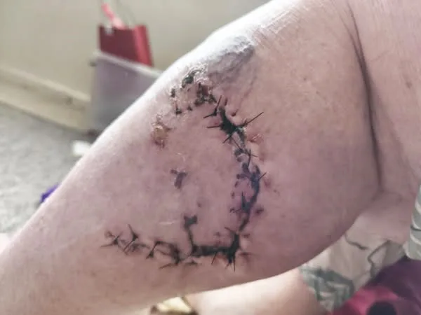 Large stitching on woman's injured leg.