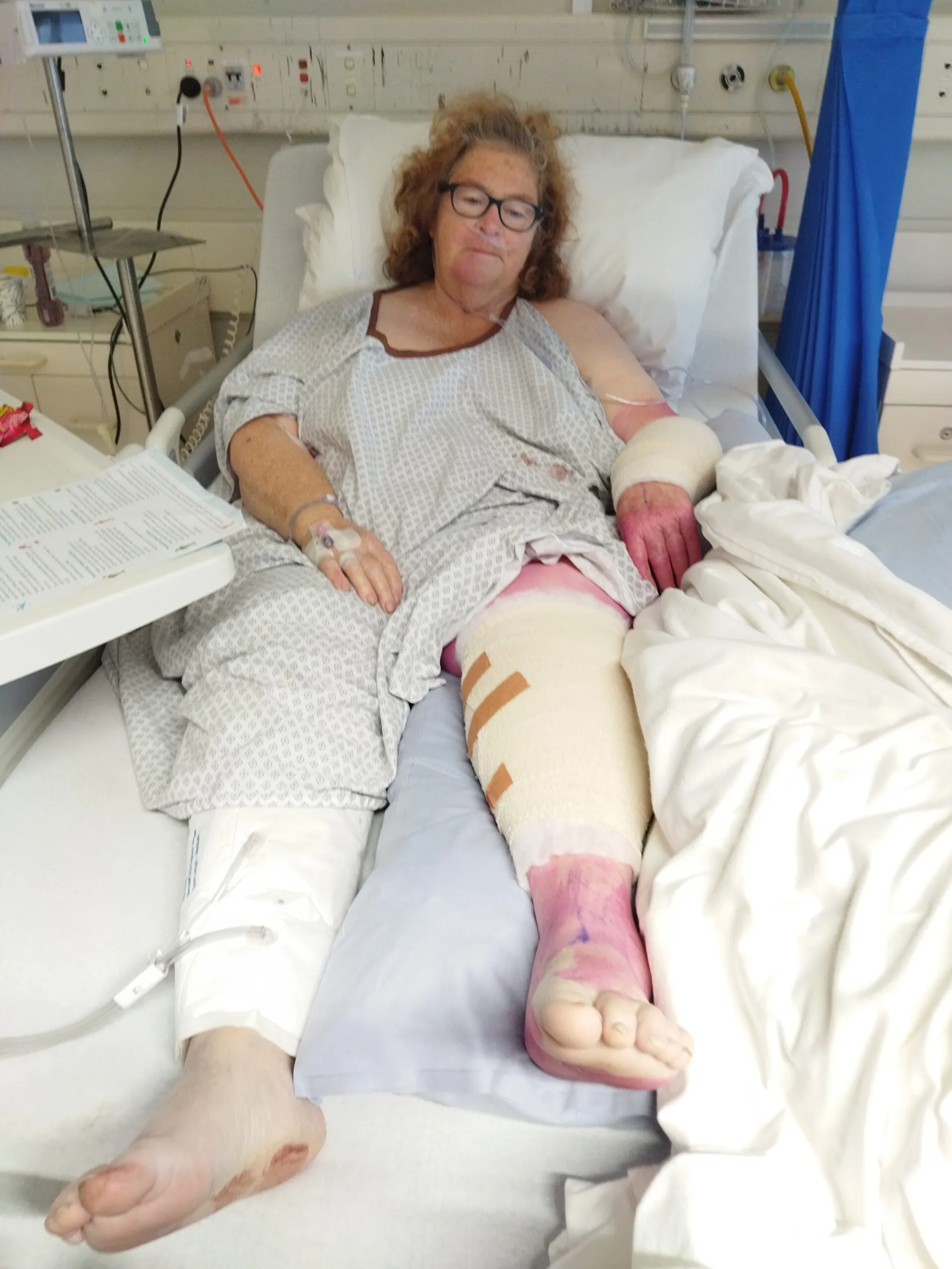 Woman with extensive injuries and bandaged leg on hospital bed.