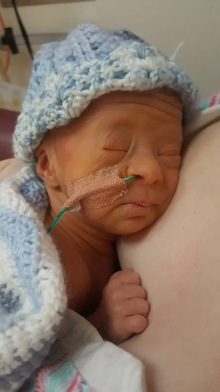 a baby with a feeding tube
