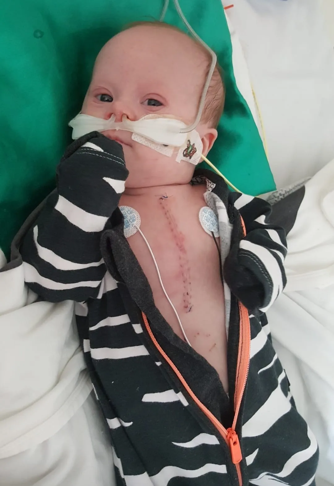 Small baby with a chest scar running vertical on his heart, wearing a zebra onesie