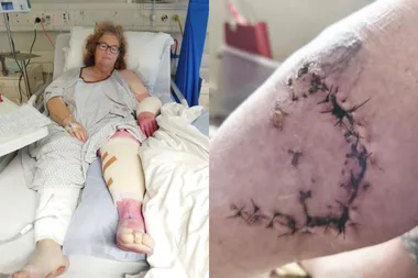 Left: Woman on hospital bed with extensive injuries on leg and arm. Right: Calf injury with big cut and multiple staples.