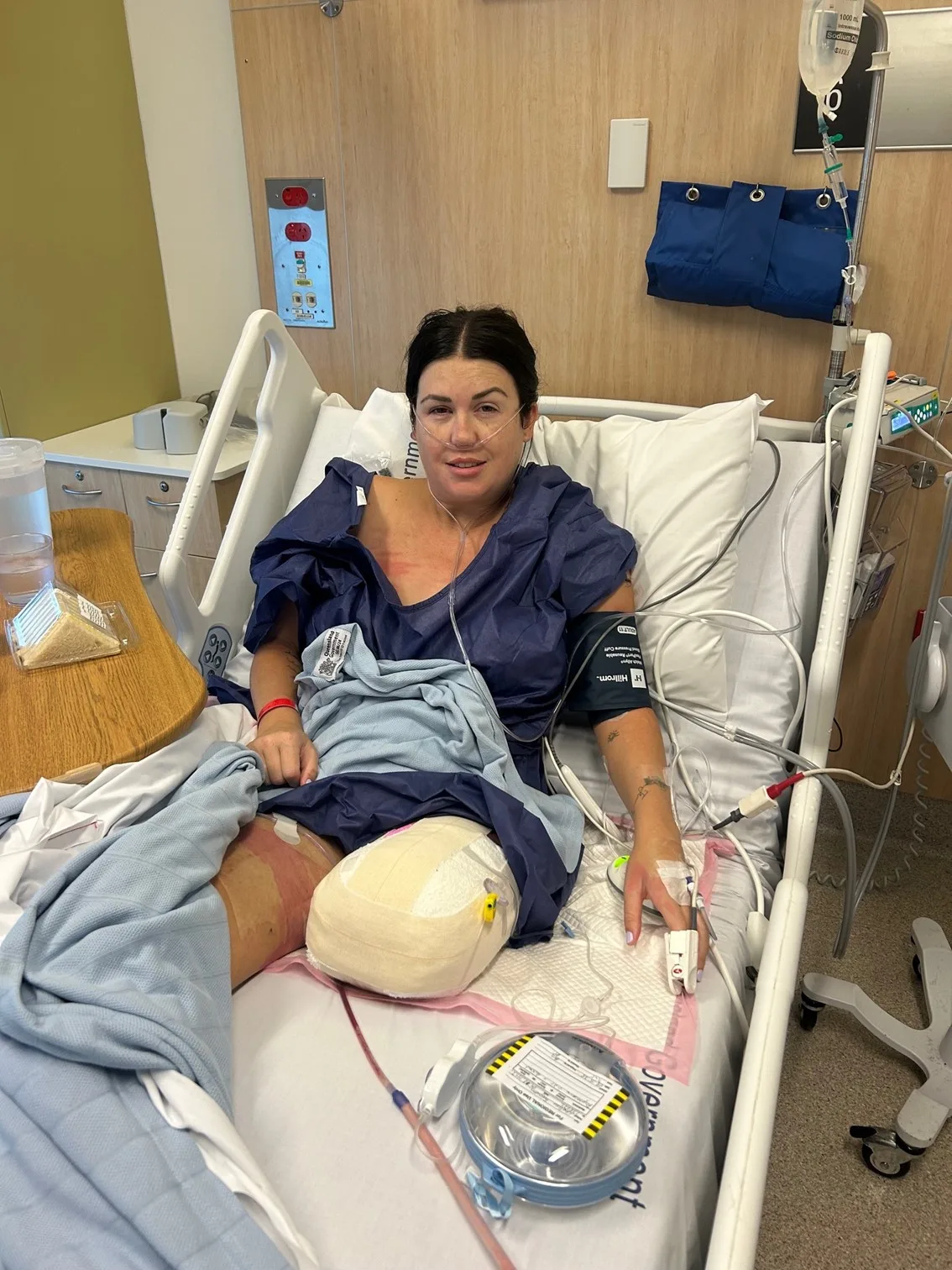 Woman in hospital bed tied to several medical tubes, with left leg amputated above the knee and remaining part of leg wrapped in bandages. 