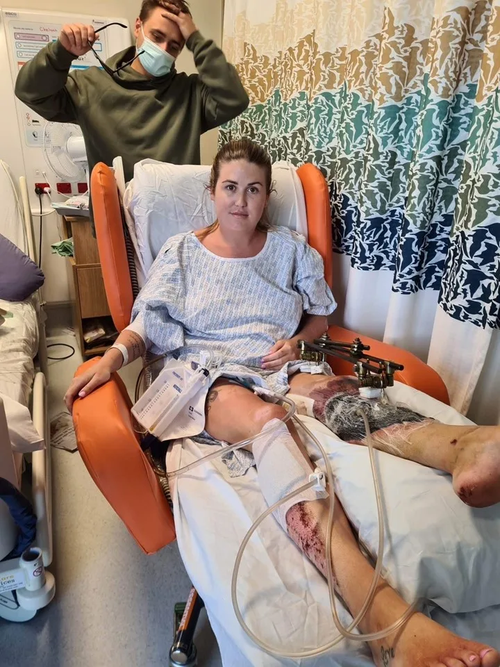Woman wearing hospital gown sitting on orange chair with massive injuries to left leg that is degloved, bruised and bleeding while right leg bandaged. 
