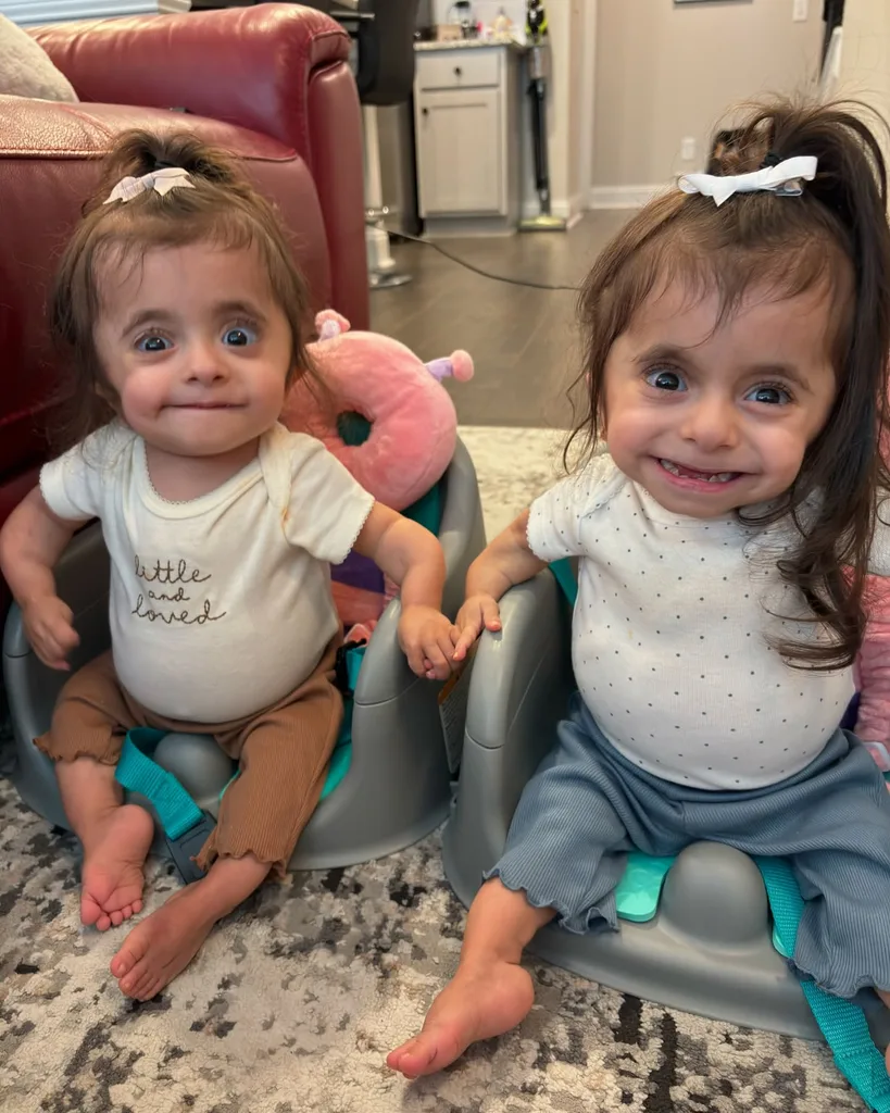 Twin girls with osteogenesis imperfecta