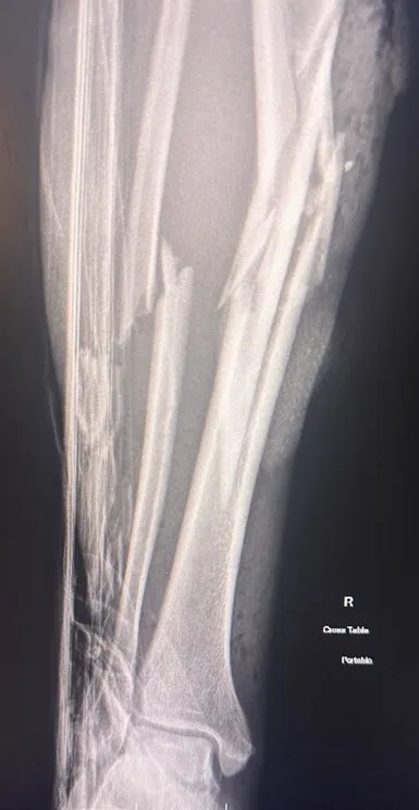 xray of broken leg