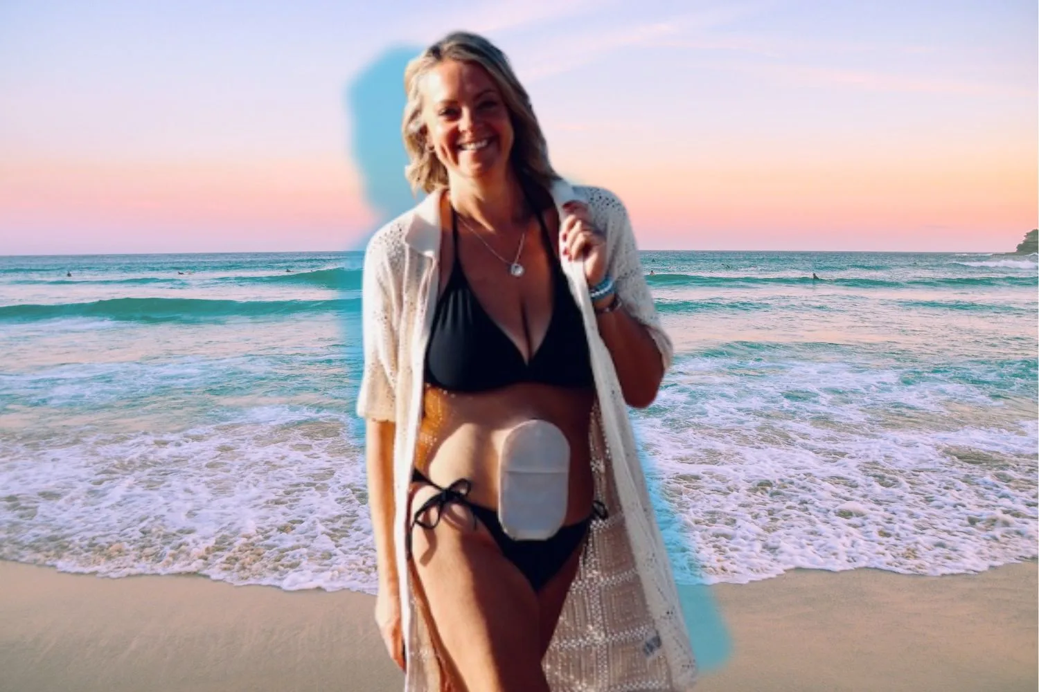 Nicole Trimboli at the beach wearing a bikini and her ostomy bag