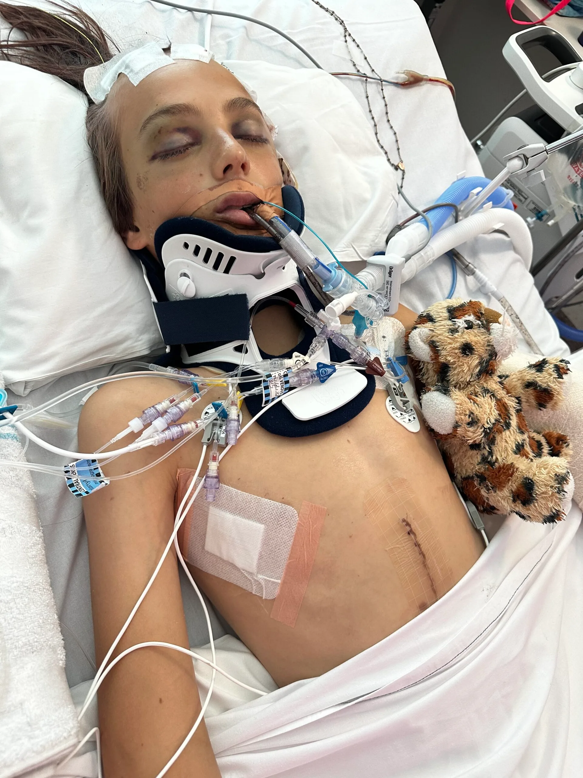 young boy covered in wires with large chest scar