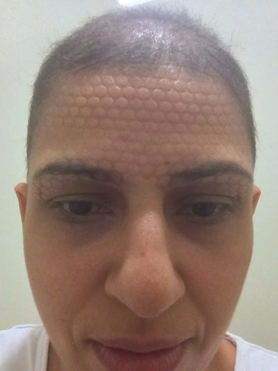 A woman with a radiation mask imprint on her forehead