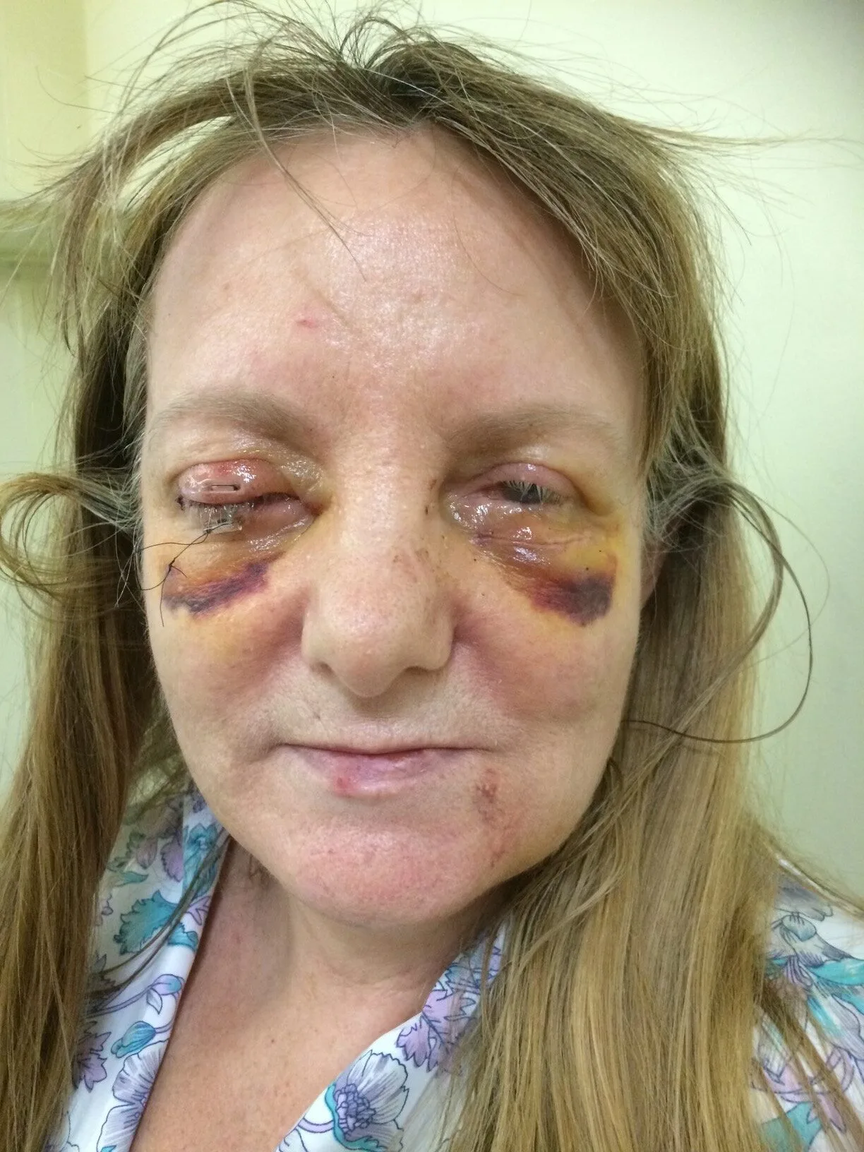 woman with eye bruises and stiches