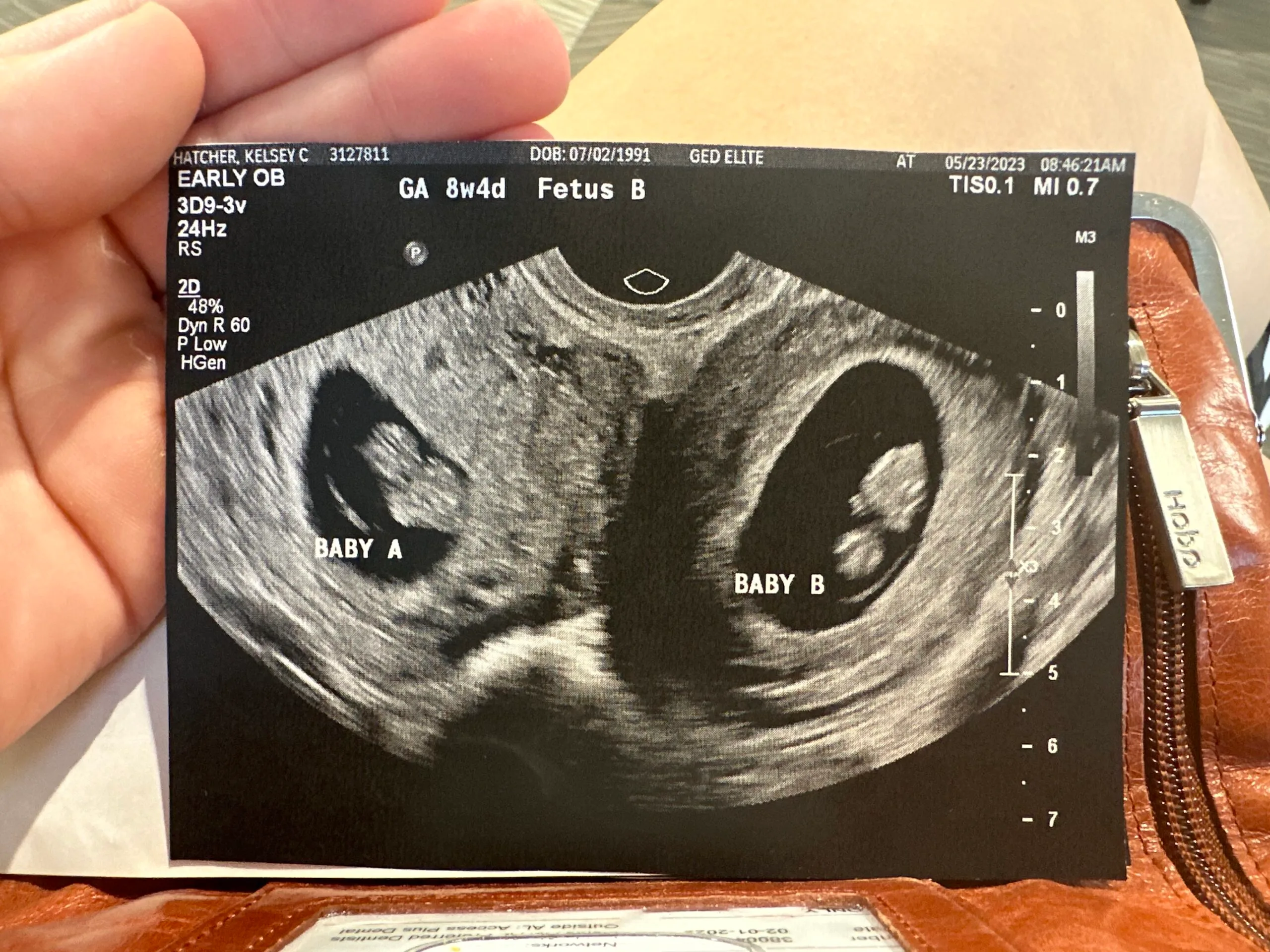 ultrasound showing baby A and B