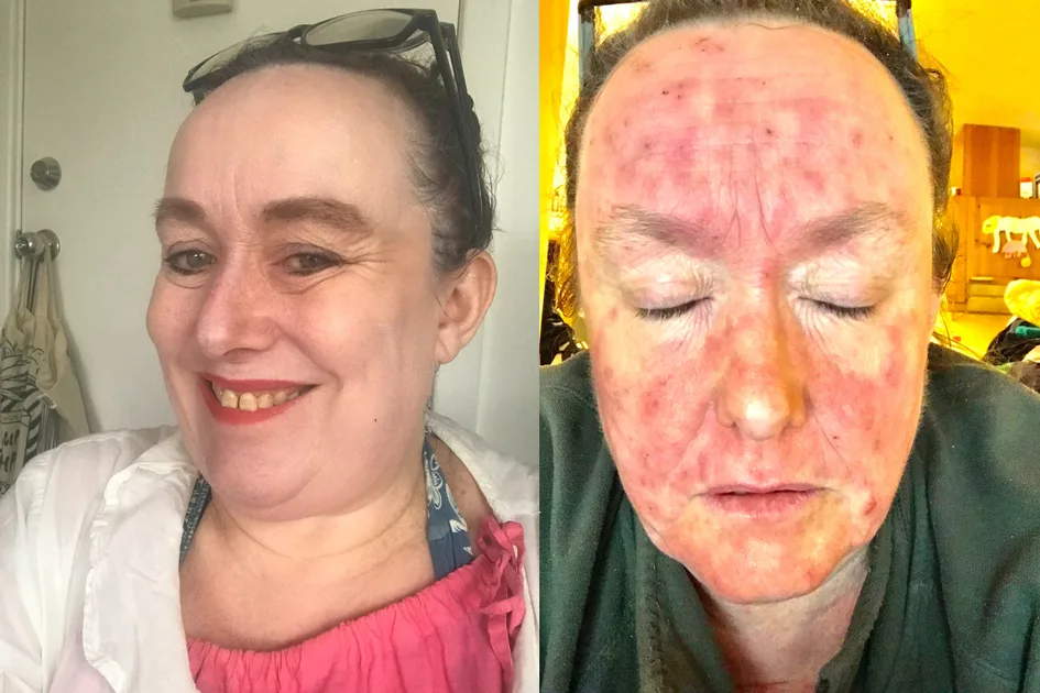 Un eczéma sévère a forcé Faye à fuir l’Australie