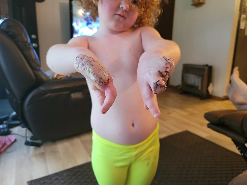 Little girl holding out both hands  showing just two pointers and thumbs. Half her right palm had also been severed.