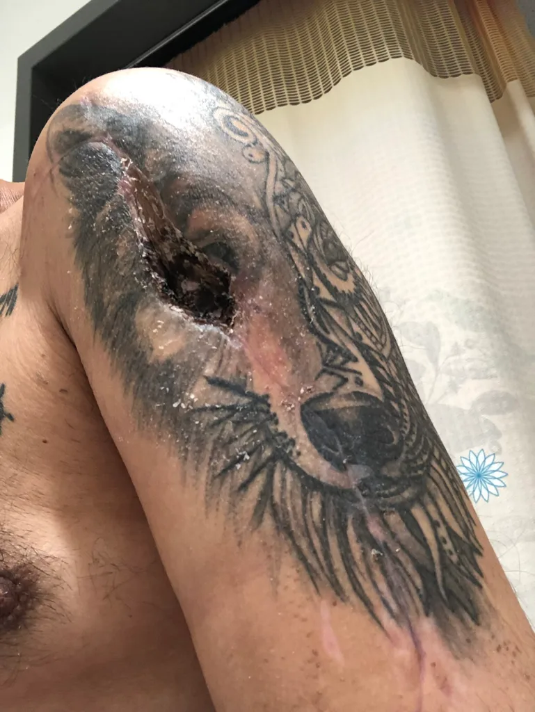 Image of bullet hole in mans arm