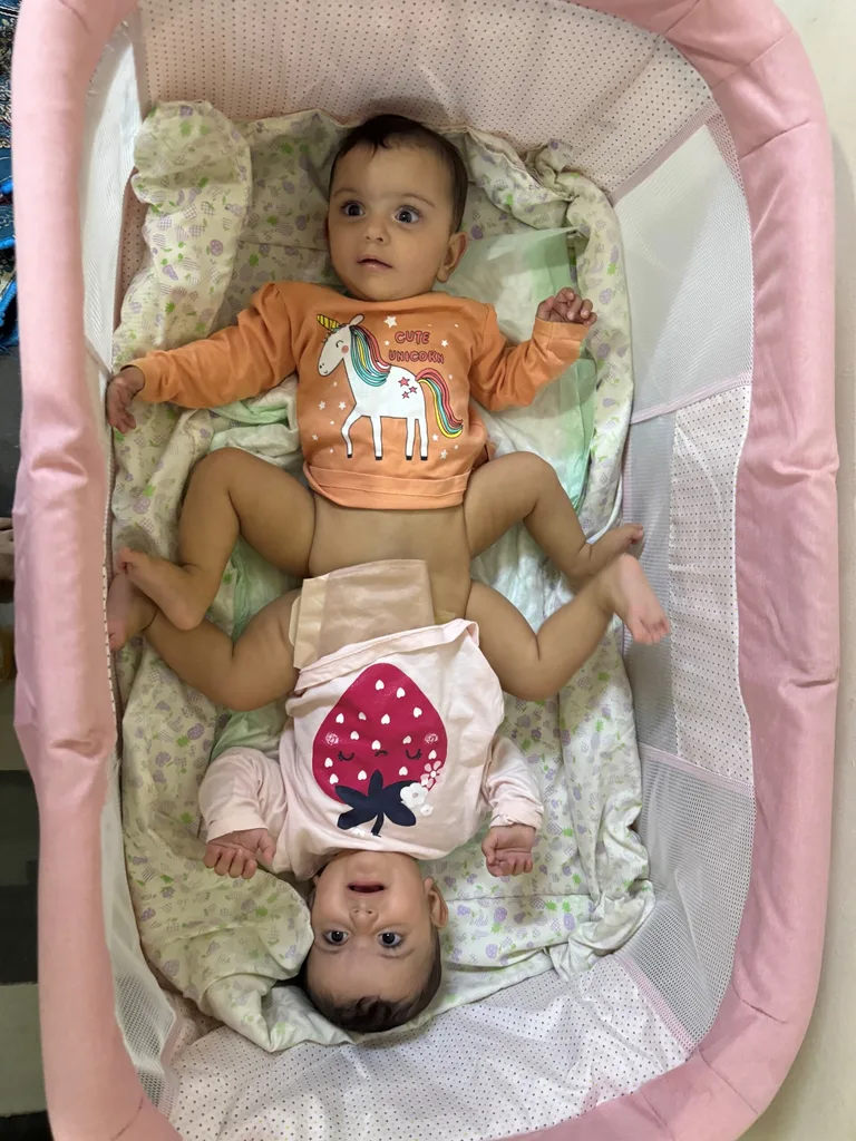 Image of twin girls conjoined at the hip