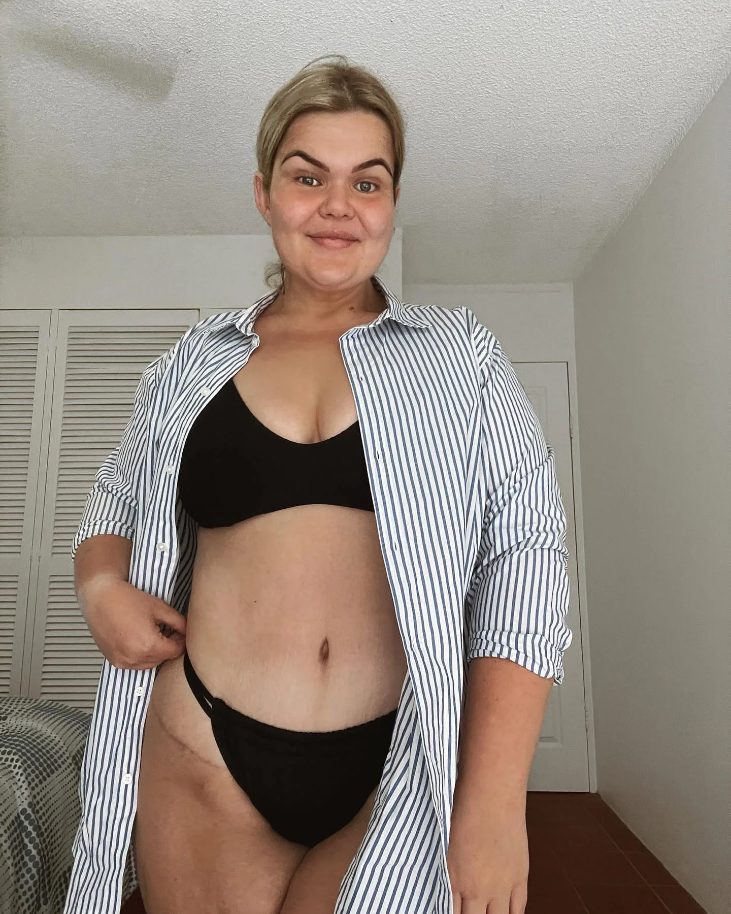 blonde girl in black bikini and striped shirt showing scars