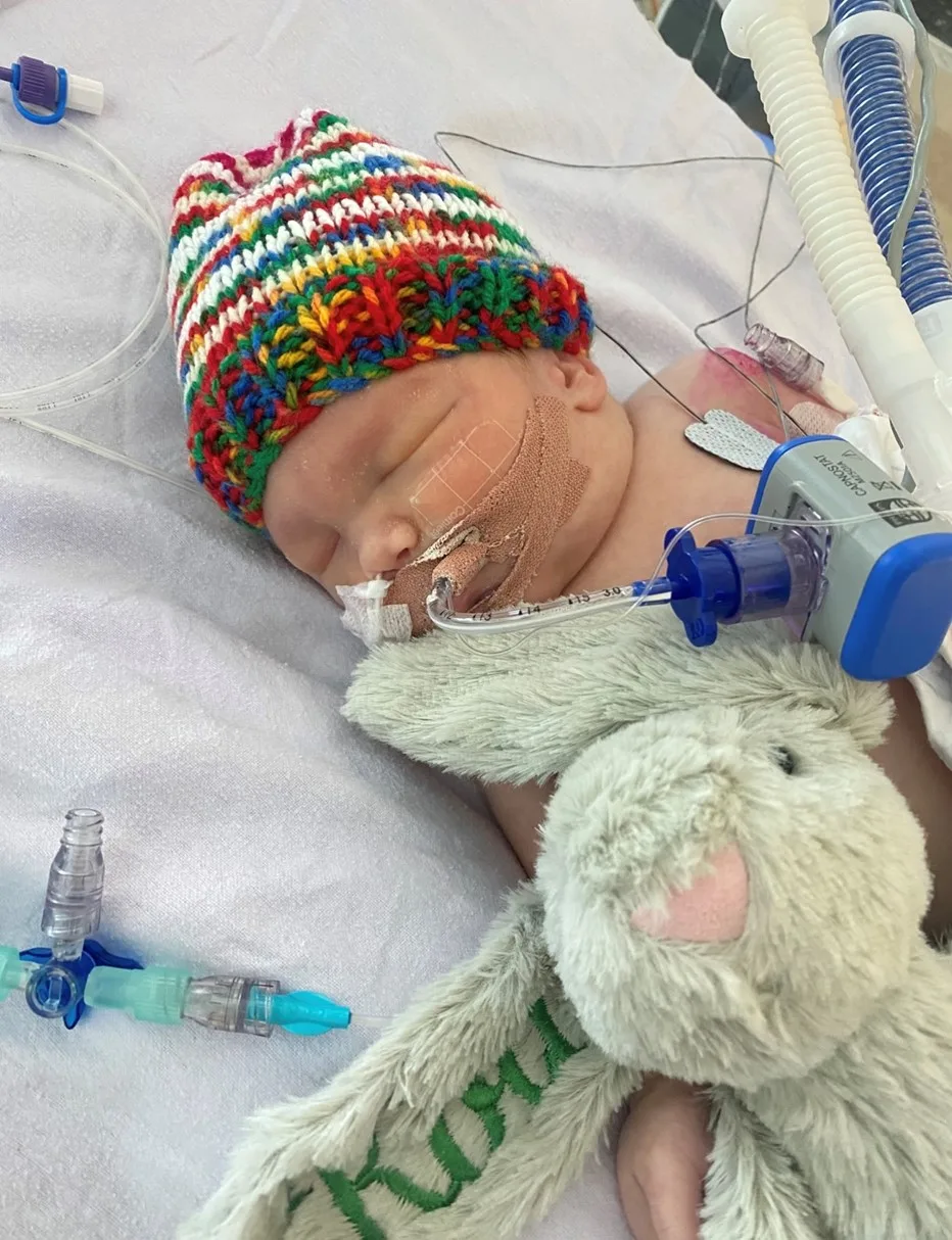 Baby Koa underwent a 17-hour surgical procedure.