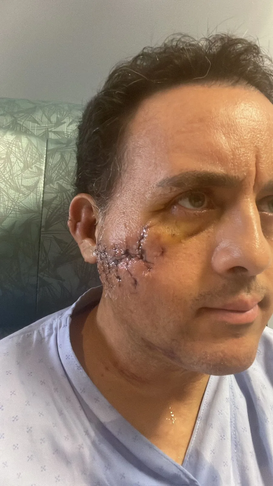 man with visible stiches on right cheek 