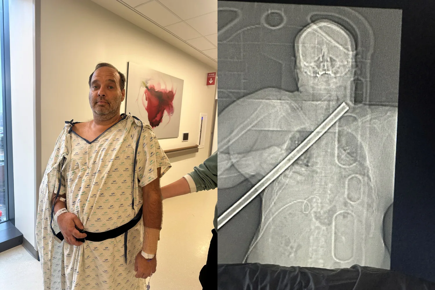 Image on left - Man recovering in hospital after DIY disaster Image on right - xray of man impaled on pipe