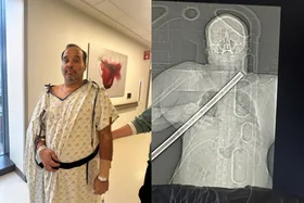 Image on left - Man recovering in hospital after DIY disaster Image on right - xray of man impaled on pipe