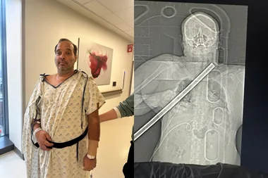 Image on left - Man recovering in hospital after DIY disaster Image on right - xray of man impaled on pipe