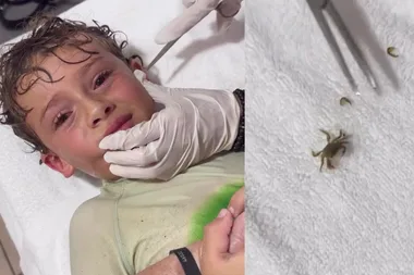 A crab was living in my boy’s ear