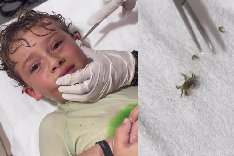 A crab was living in my boy’s ear